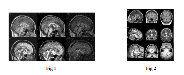 Brain Anamoly detection